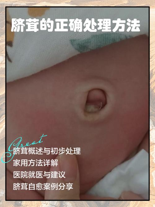 新生儿肚脐上的白肉是什么？需要处理吗？附图片详解。-第1张图片-郑州医学网