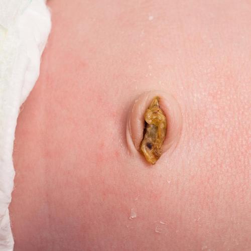 新生儿肚脐上的白肉是什么？需要处理吗？附图片详解。-第3张图片-郑州医学网