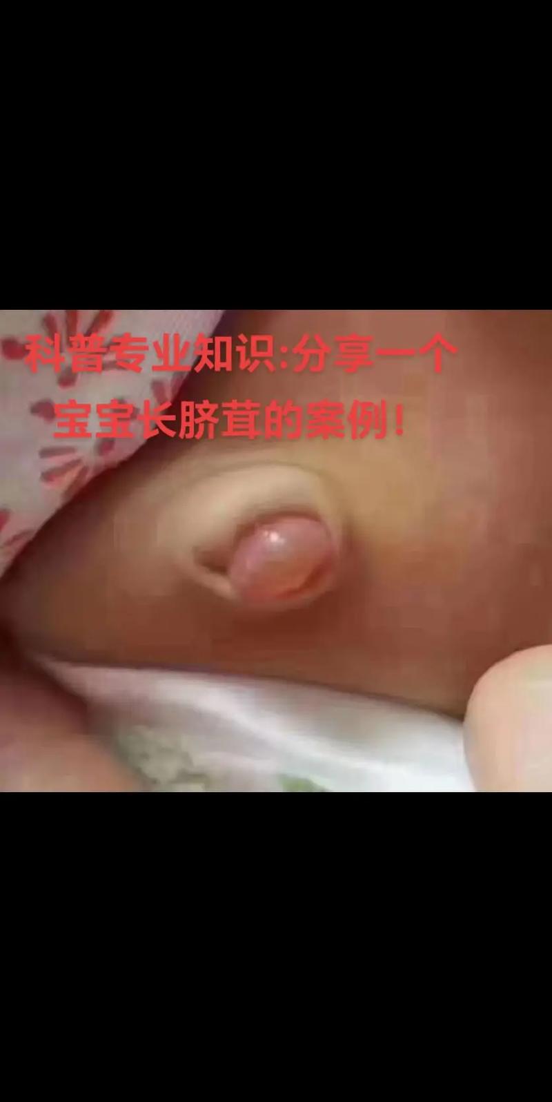 新生儿肚脐上的白肉是什么？需要处理吗？附图片详解。-第2张图片-郑州医学网