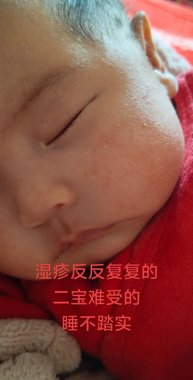 新生儿红色疹子带白头是痱子还是感染？需就医处理吗？-第1张图片-郑州医学网