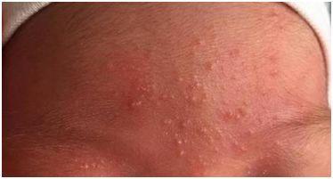 新生儿红色疹子带白头是痱子还是感染？需就医处理吗？-第2张图片-郑州医学网