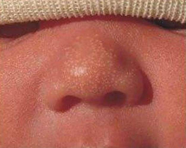 新生儿红色疹子带白头是痱子还是感染？需就医处理吗？-第3张图片-郑州医学网