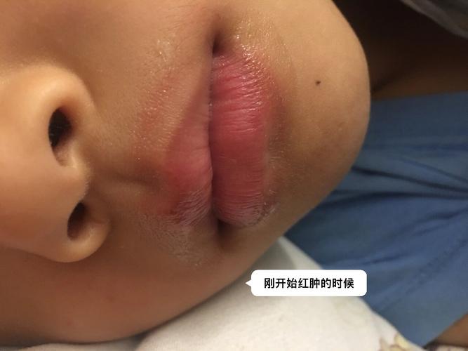新生儿嘴巴周围起红疹是过敏还是护理不当？该怎么处理？-第3张图片-郑州医学网