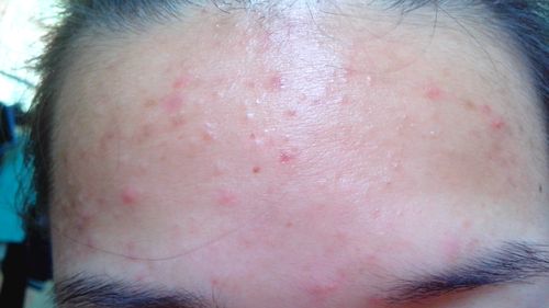 怀孕期间额头频长小痘痘，是激素波动还是营养失衡在作祟？-第2张图片-郑州医学网