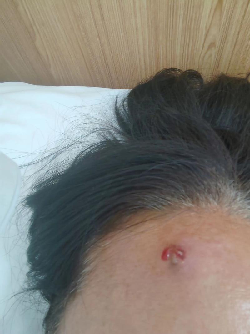 怀孕期间额头频长小痘痘，是激素波动还是营养失衡在作祟？-第3张图片-郑州医学网