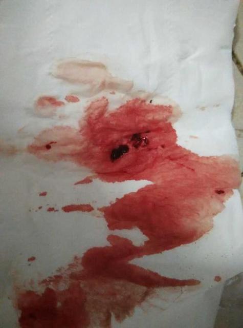 怀孕期间流产是否一定会伴随流血？还有哪些其他症状需要警惕？-第1张图片-郑州医学网