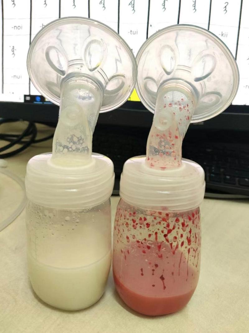 新生儿误食化脓奶水后,家长该如何紧急处理并预防后续感染?-第1张图片-郑州医学网 新生儿误食化脓奶水后,家长该如何紧急处理并预防后续感染?-第1张图片-郑州医学网