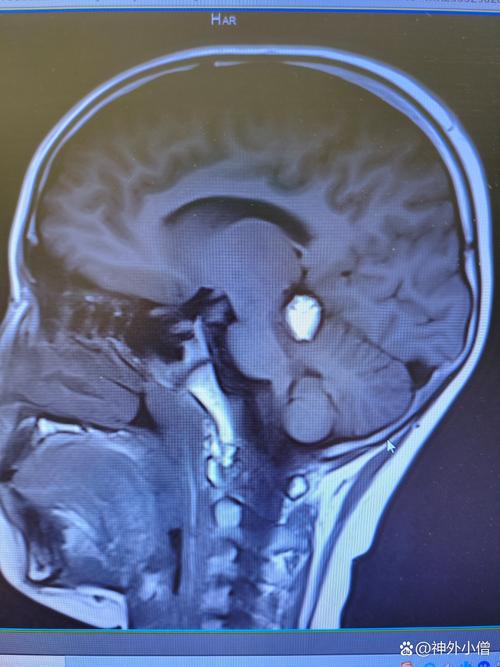 儿童脑瘤的发病诱因有哪些？遗传、环境还是其他未知因素在作祟？-第2张图片-郑州医学网