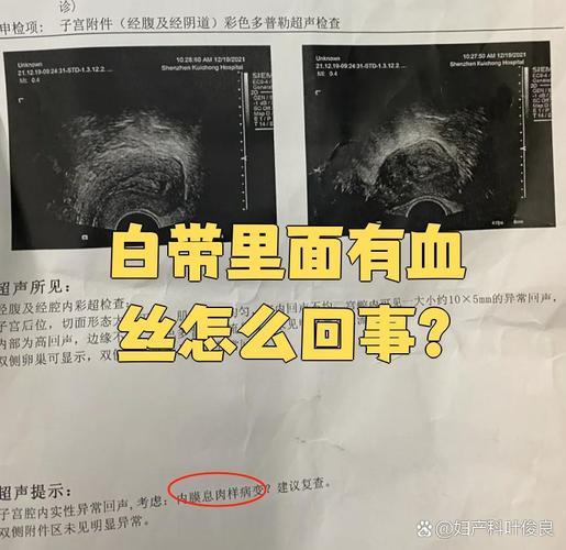 孕期白带出现血丝是危险信号吗？需要立即就医吗？-第1张图片-郑州医学网