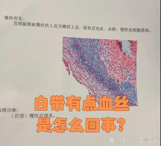 孕期白带出现血丝是危险信号吗？需要立即就医吗？-第2张图片-郑州医学网