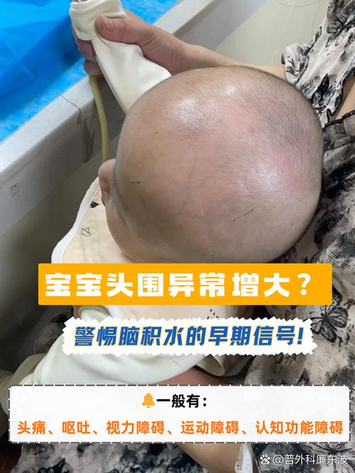 新生儿脑积水有哪些典型症状？家长如何通过日常观察发现异常？-第1张图片-郑州医学网
