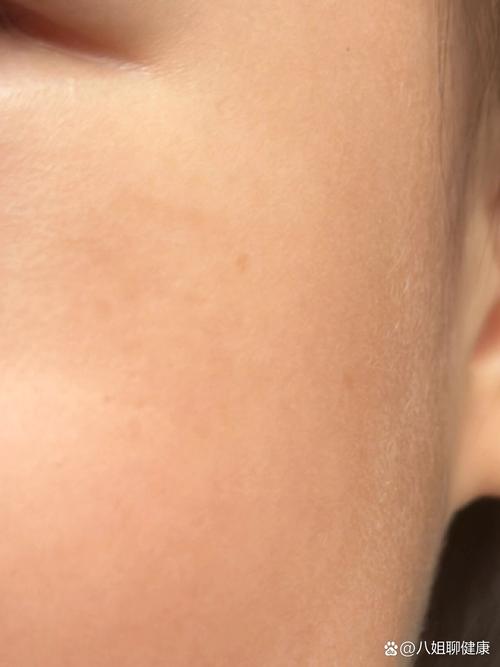 儿童长雀斑必须治疗吗？不治疗会加重吗？有哪些安全有效的办法？-第2张图片-郑州医学网