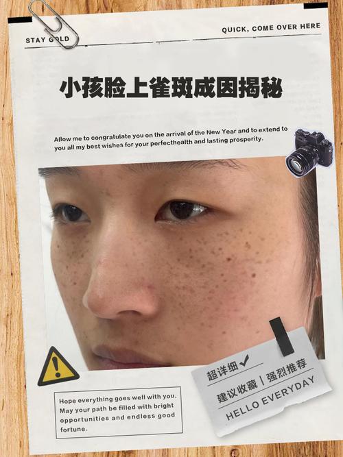 儿童长雀斑必须治疗吗？不治疗会加重吗？有哪些安全有效的办法？-第1张图片-郑州医学网