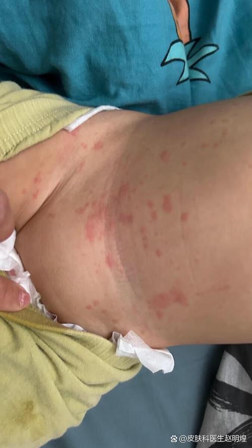 儿童出风疹的症状图片有哪些典型表现？如何通过图片识别与普通皮疹的区别？-第1张图片-郑州医学网