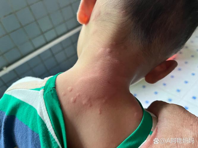 儿童出风疹的症状图片有哪些典型表现？如何通过图片识别与普通皮疹的区别？-第2张图片-郑州医学网