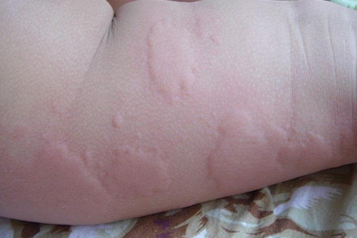 儿童出风疹的症状图片有哪些典型表现？如何通过图片识别与普通皮疹的区别？-第3张图片-郑州医学网