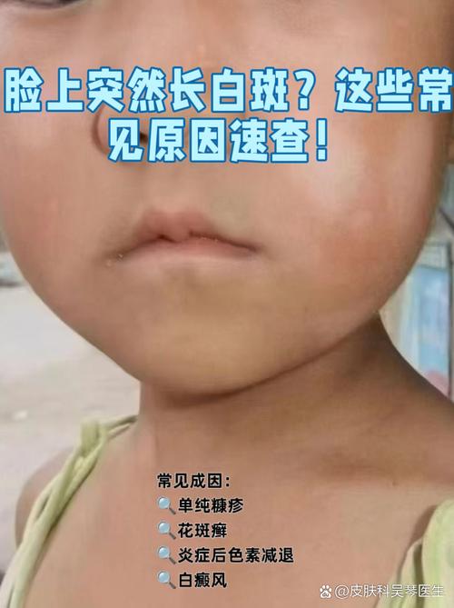 儿童脸上长白斑图片是什么原因？需要警惕哪些疾病？-第1张图片-郑州医学网