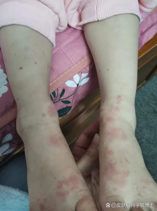 儿童紫癜多久能治好？治疗周期受哪些因素影响？家长该如何科学应对？-第3张图片-郑州医学网