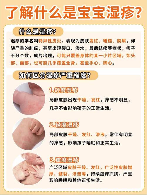 儿童皮肤湿疹反复发作，如何科学治疗才能有效止痒且不复发？-第2张图片-郑州医学网