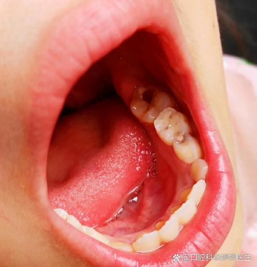 儿童坏牙牙根外露是什么原因导致的？如何有效预防与治疗？-第2张图片-郑州医学网