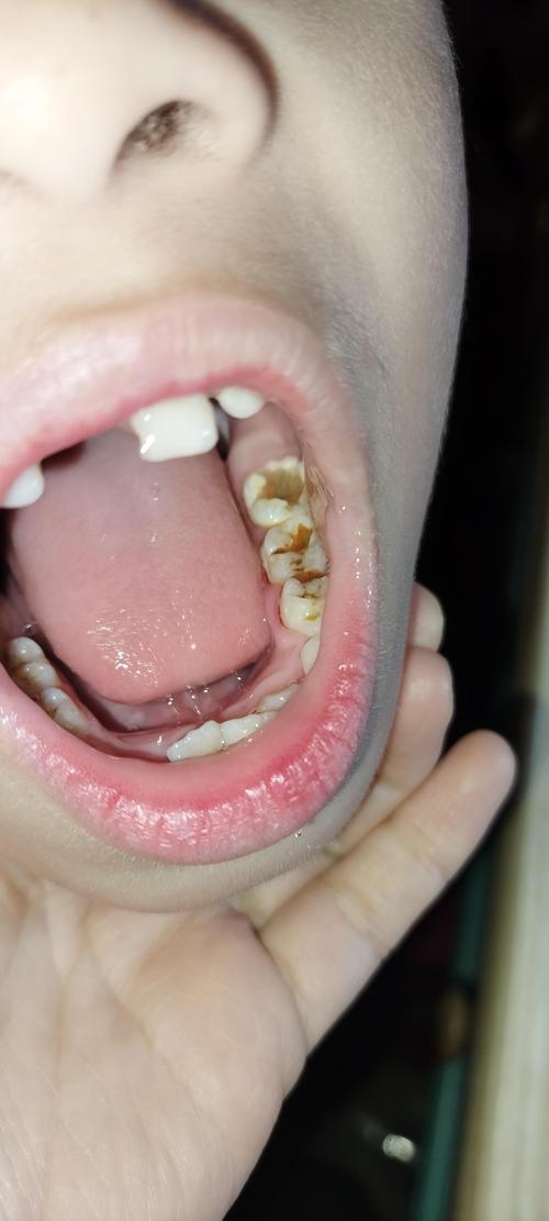 儿童坏牙牙根外露是什么原因导致的？如何有效预防与治疗？-第1张图片-郑州医学网