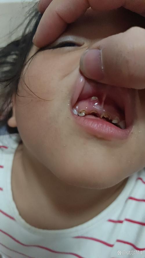 儿童坏牙牙根外露是什么原因导致的？如何有效预防与治疗？-第3张图片-郑州医学网