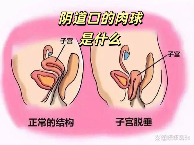 怀孕期间阴壁膨出图片-第1张图片-郑州医学网