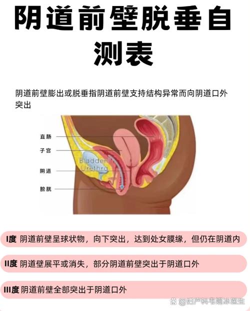 怀孕期间阴壁膨出图片-第2张图片-郑州医学网