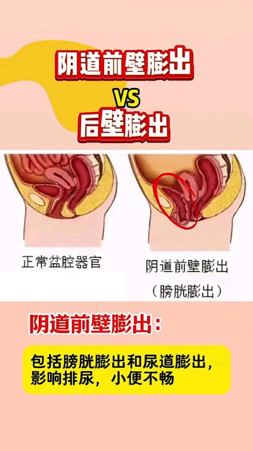 怀孕期间阴壁膨出图片-第3张图片-郑州医学网