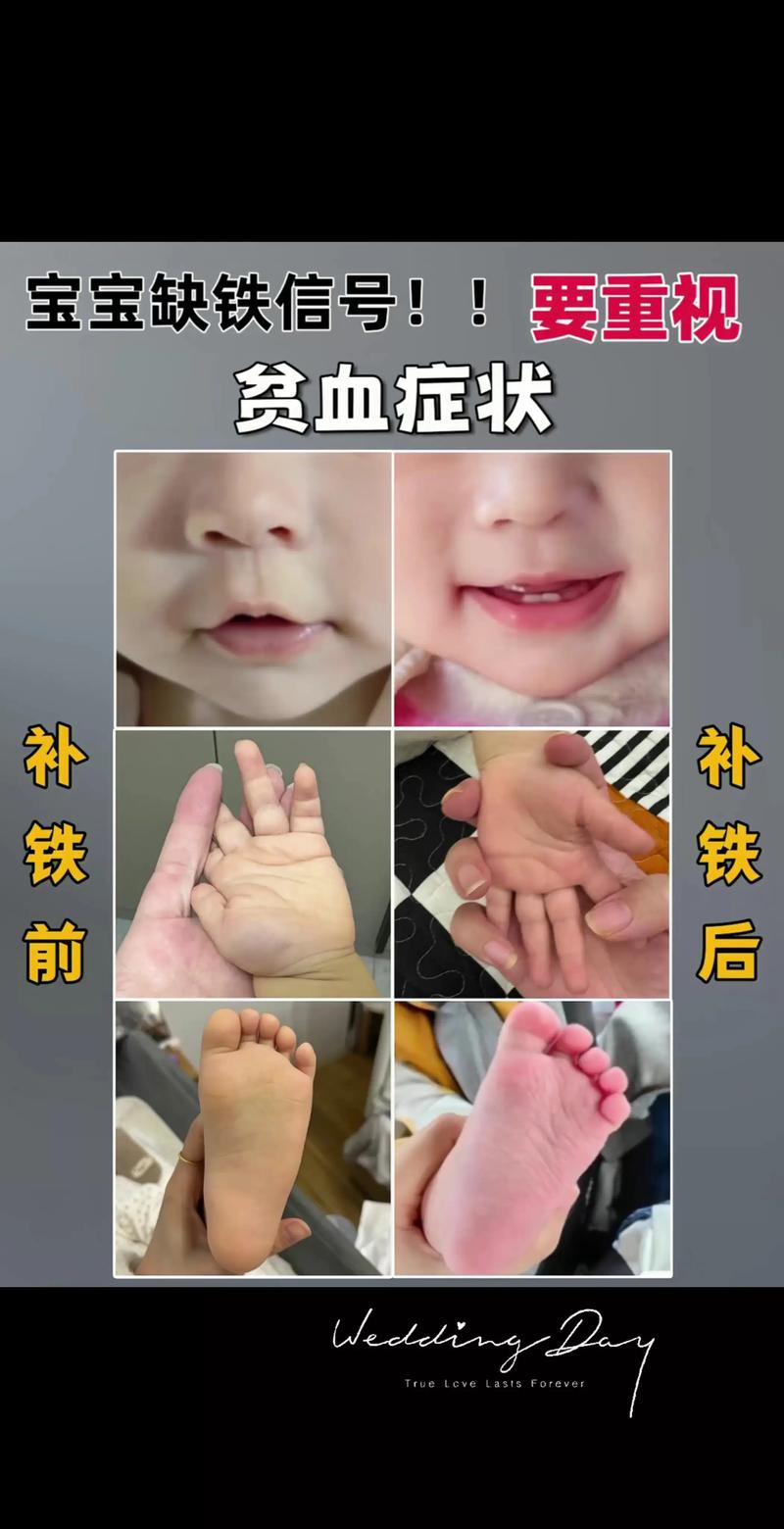 新生儿贫血输血风险大吗?严重程度和哪些因素有关?-第1张图片-郑州医学网 新生儿贫血输血风险大吗?严重程度和哪些因素有关?-第1张图片-郑州医学网