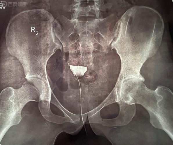 备孕期间意外拍了X片，孩子还能要吗？辐射影响有多大？-第3张图片-郑州医学网