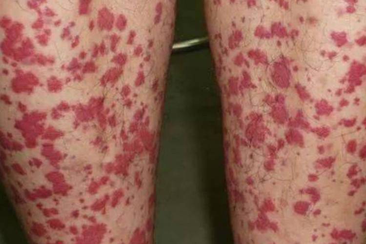 儿童过敏性紫癜会传染给其他小朋友吗？家长需要做好哪些预防措施？-第2张图片-郑州医学网