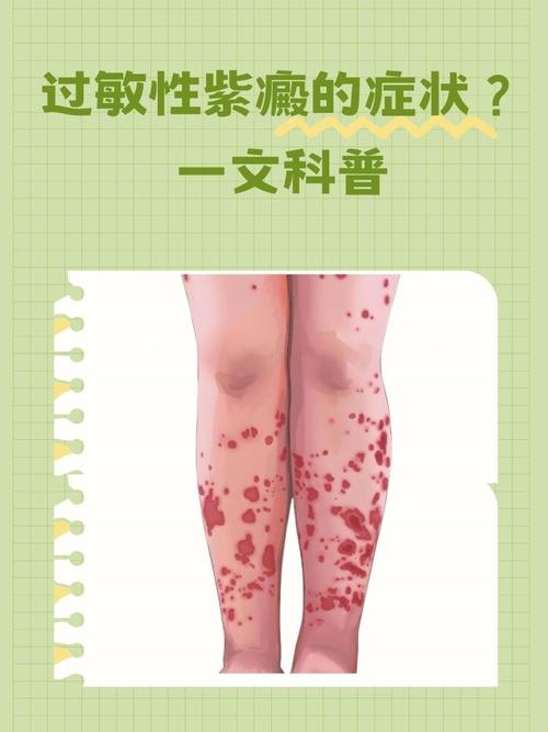 儿童过敏性紫癜会传染给其他小朋友吗？家长需要做好哪些预防措施？-第1张图片-郑州医学网