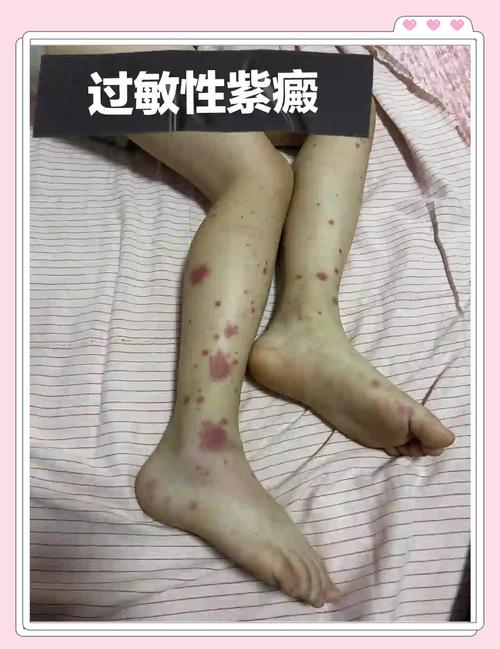 儿童过敏性紫癜会传染给其他小朋友吗？家长需要做好哪些预防措施？-第3张图片-郑州医学网