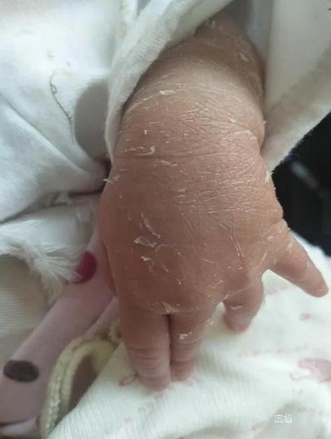 两个月新生儿脸黄手白是正常生理现象还是健康异常信号？-第2张图片-郑州医学网