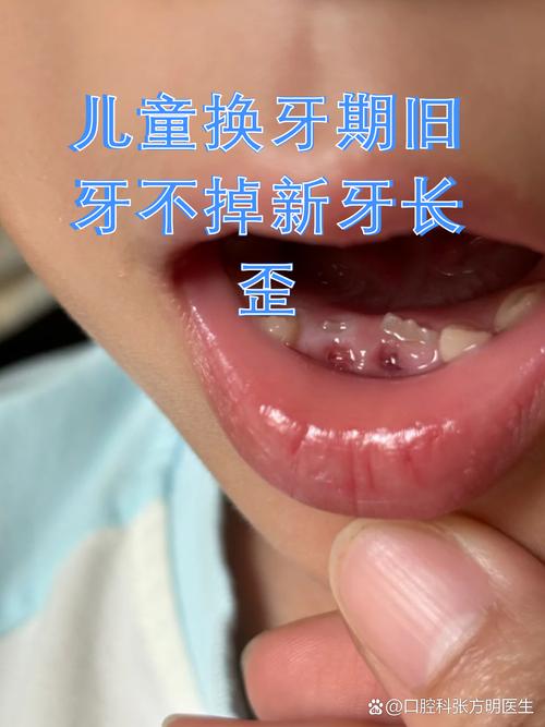 儿童牙齿间隙大是正常现象吗？需要干预吗？会影响后续换牙吗？-第2张图片-郑州医学网