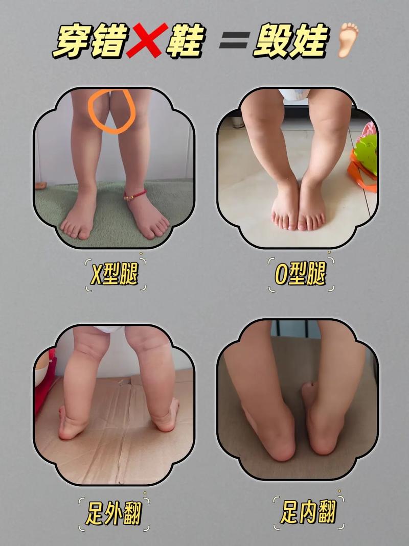 新生儿脚一直弯在那里是正常现象吗？需要干预吗？-第2张图片-郑州医学网