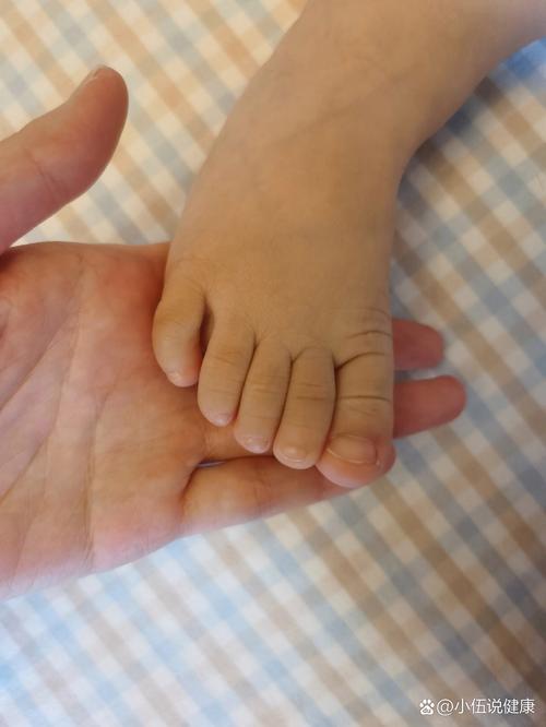 新生儿脚一直弯在那里是正常现象吗？需要干预吗？-第1张图片-郑州医学网