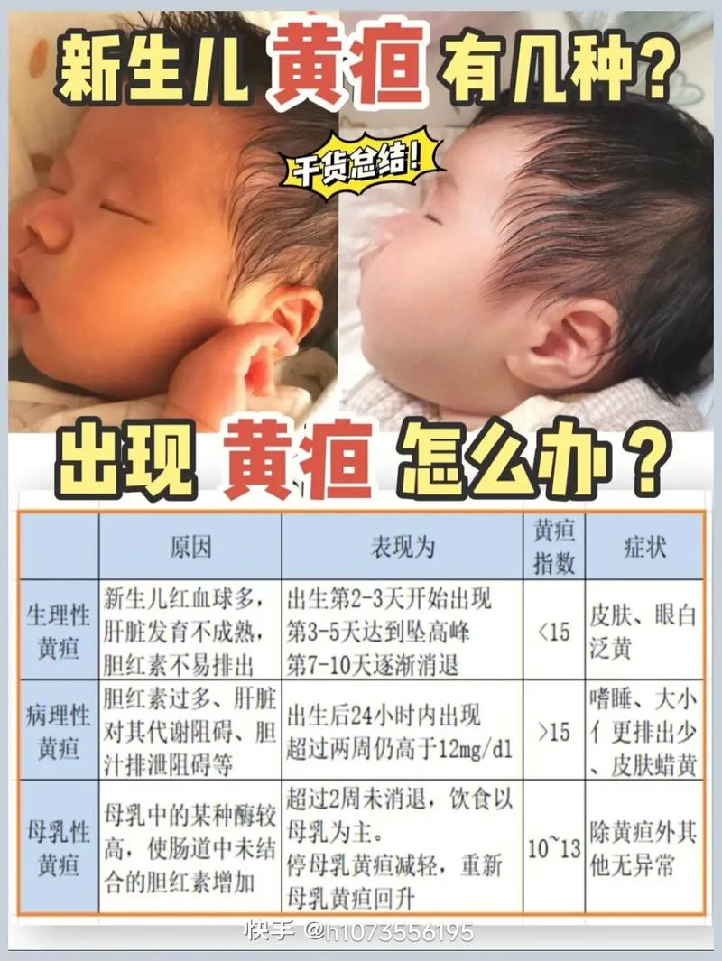 新生儿四个月黄疸不退,是病理性黄疸还是代谢异常?-第2张图片-郑州医学网 新生儿四个月黄疸不退,是病理性黄疸还是代谢异常?-第2张图片-郑州医学网