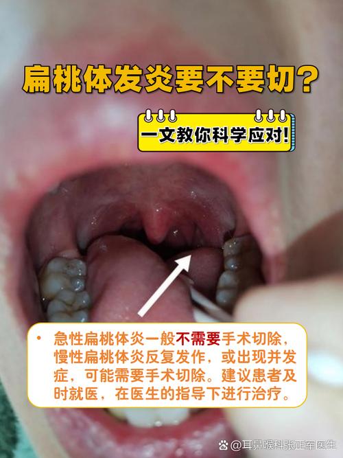 儿童扁桃体肿大到底该怎么治？手术还是保守治疗？家长该如何选择？-第2张图片-郑州医学网