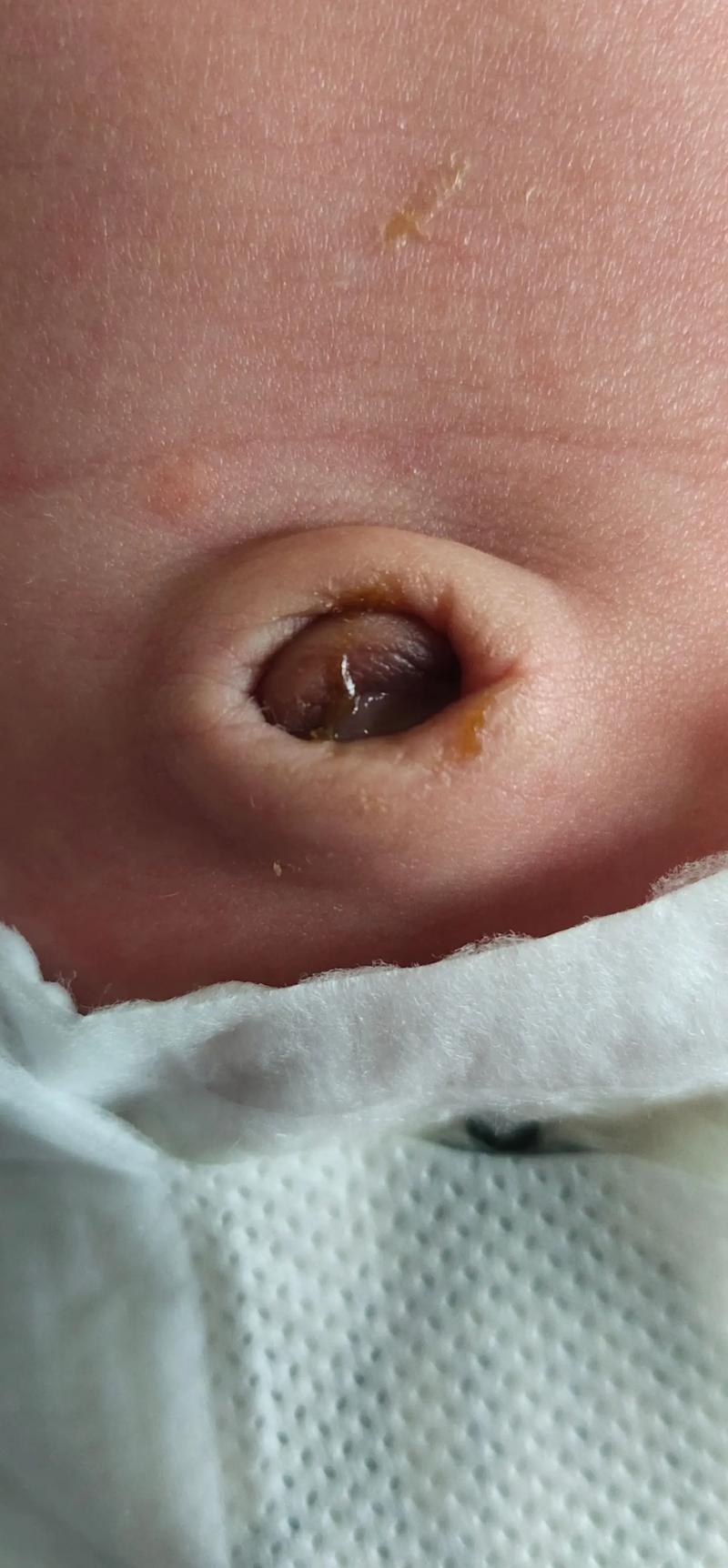 新生儿二次断脐是更科学还是 unnecessary 风险?真的有必要尝试吗?-第1张图片-郑州医学网 新生儿二次断脐是更科学还是 unnecessary 风险?真的有必要尝试吗?-第1张图片-郑州医学网