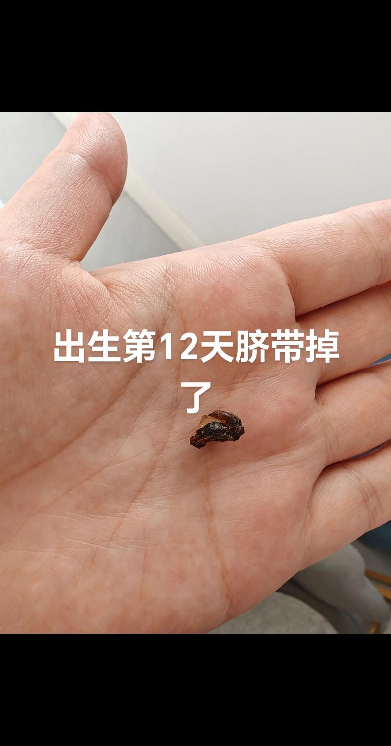 新生儿二次断脐是更科学还是 unnecessary 风险?真的有必要尝试吗?-第2张图片-郑州医学网 新生儿二次断脐是更科学还是 unnecessary 风险?真的有必要尝试吗?-第2张图片-郑州医学网