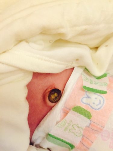 新生儿第九天脐带出血是正常现象还是异常情况？需要如何正确处理？-第1张图片-郑州医学网