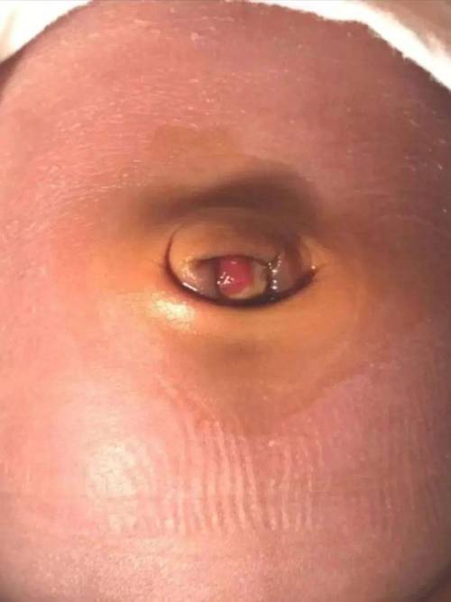 新生儿第九天脐带出血是正常现象还是异常情况？需要如何正确处理？-第2张图片-郑州医学网