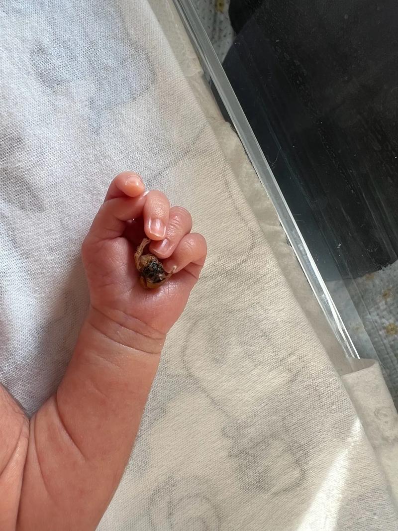 新生儿第九天脐带出血是正常现象还是异常情况？需要如何正确处理？-第3张图片-郑州医学网