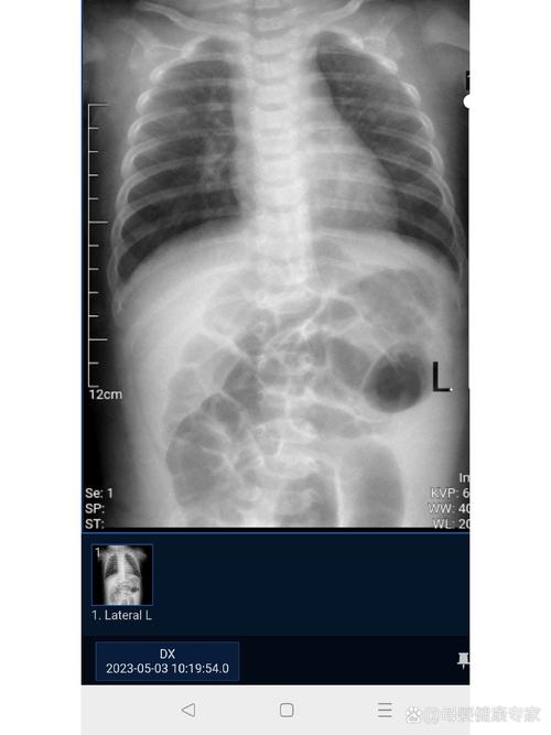 新生儿肺透明膜病的X线影像有哪些典型表现及诊断要点?-第2张图片-郑州医学网 新生儿肺透明膜病的X线影像有哪些典型表现及诊断要点?-第2张图片-郑州医学网
