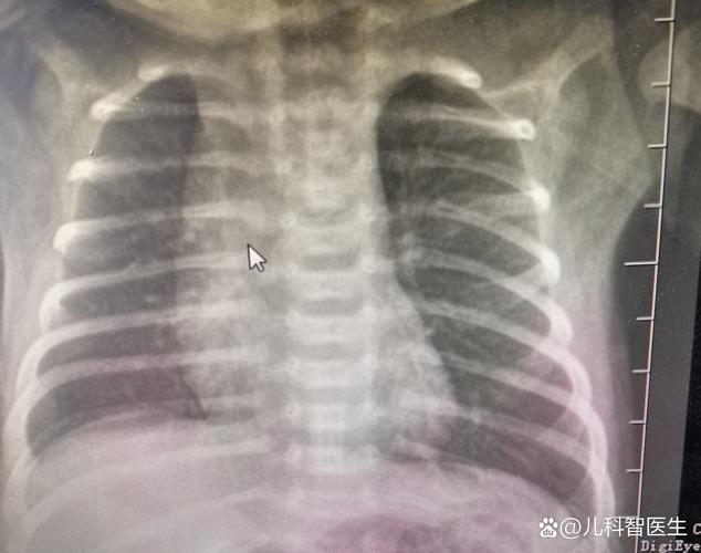 新生儿肺透明膜病的X线影像有哪些典型表现及诊断要点？-第3张图片-郑州医学网