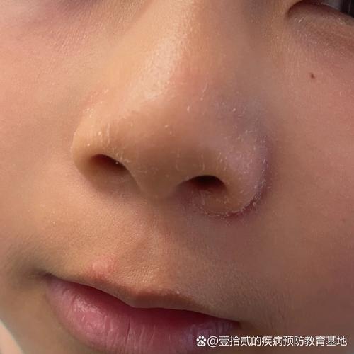 新生儿鼻翼两侧有黄痂-第1张图片-郑州医学网 新生儿鼻翼两侧有黄痂-第1张图片-郑州医学网