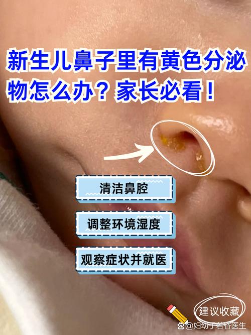 新生儿鼻翼两侧有黄痂-第2张图片-郑州医学网