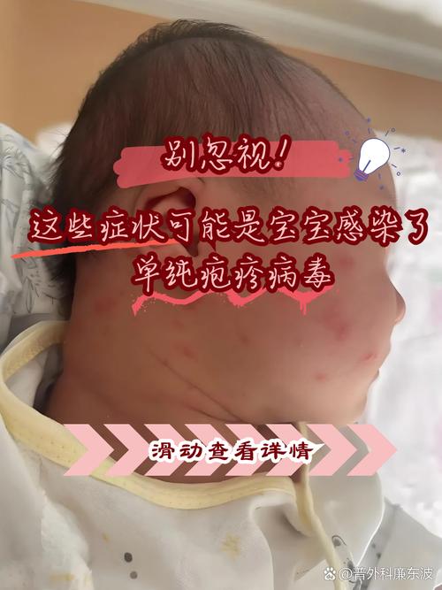 儿童病毒性发烧的症状-第3张图片-郑州医学网